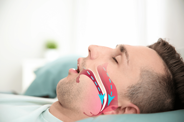 Myofunctional Therapy: A Promising Treatment for Obstructive Sleep Apnea